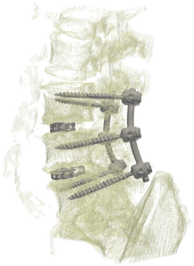 Bisegmental instrumented fusion