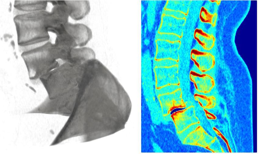Dislocation of the fourth and fifth vertebra